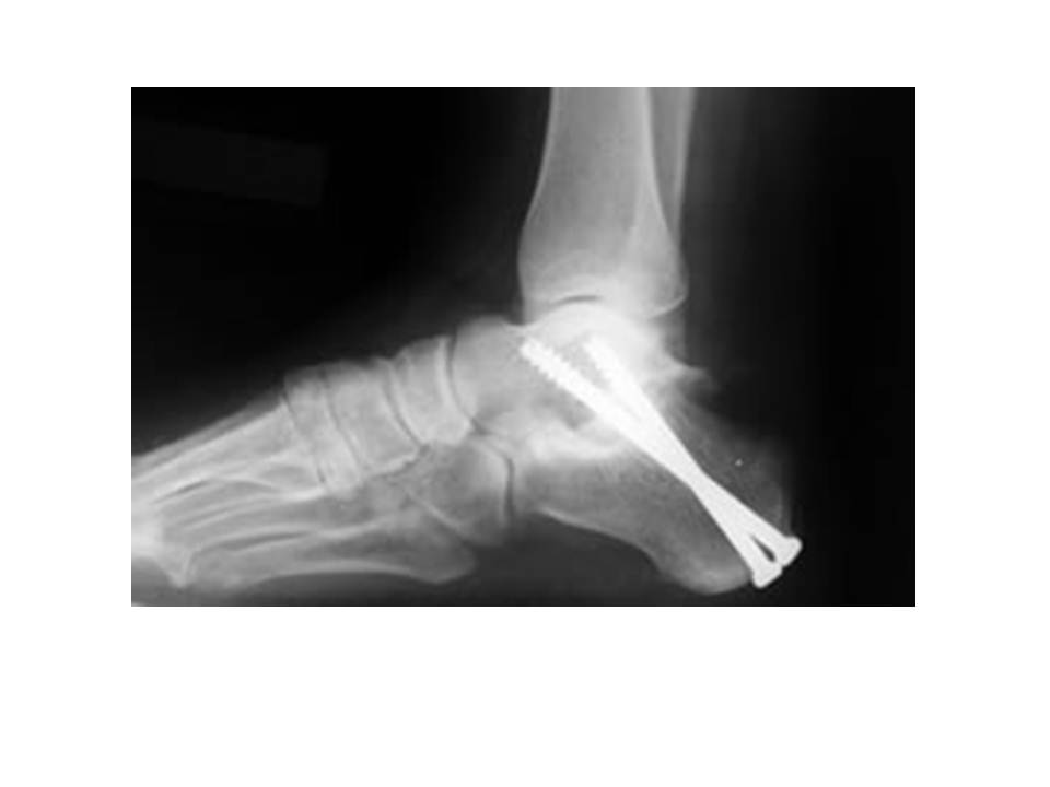 Ankle Arthrodesis Foot & Ankle Orthobullets